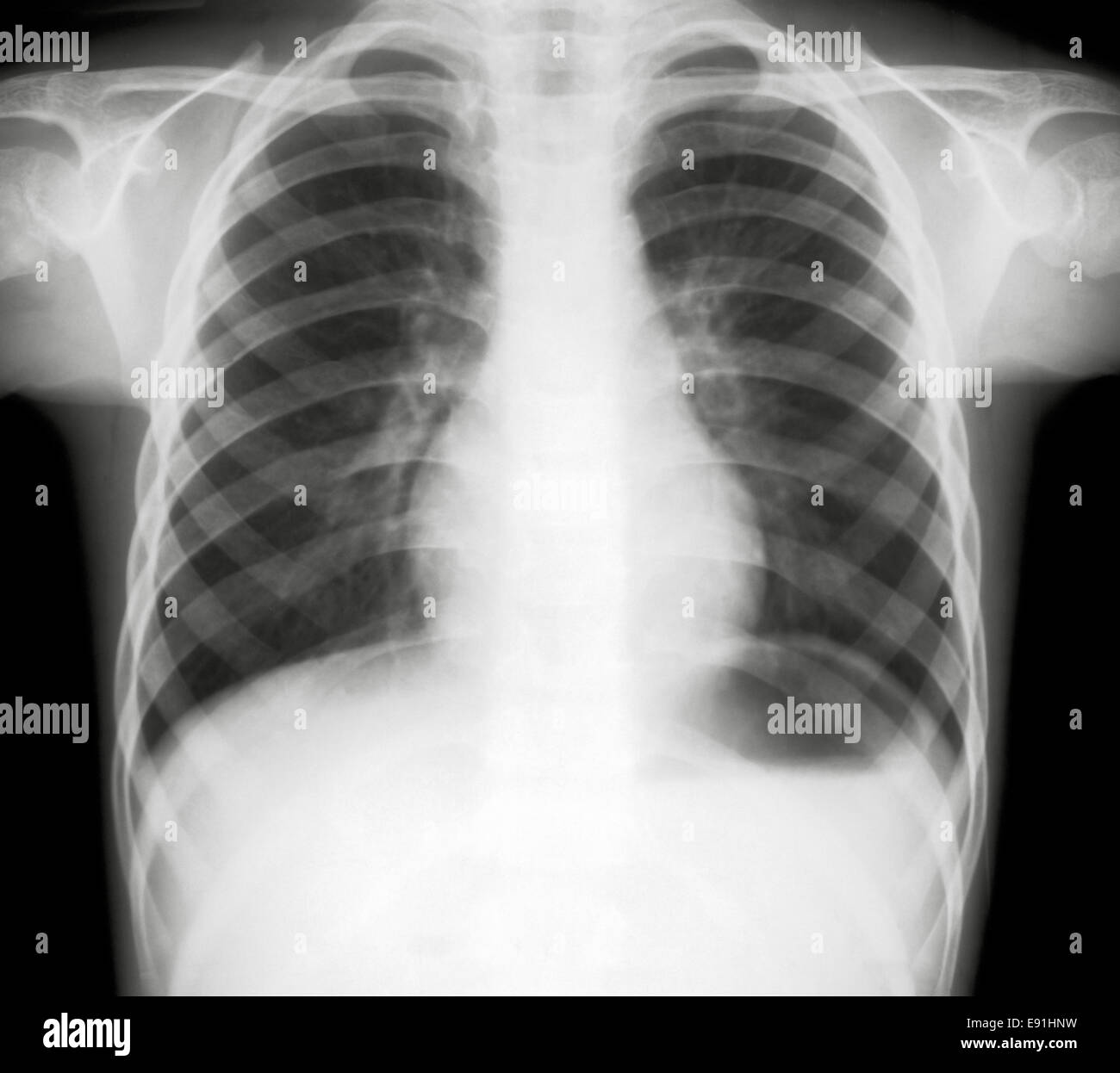Röntgen der menschlichen Lunge Stockfotografie - Alamy