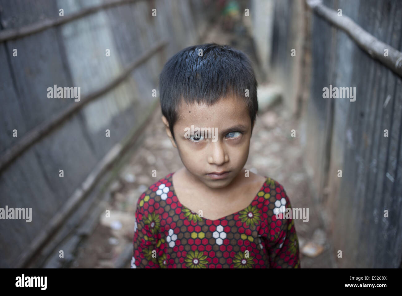 Dhaka, Bangladesch. 17. Oktober 2014. SANJIDA, 5 Jahre, lebt in Dhaka Slum, verloren ihr linkes Auge, wenn sie nur ein paar Monate alt war. Dhaka ist wohl die meistbesuchte Stadt der Welt mit Klima Migration fahren die Bevölkerungsexplosion. © Suvra Kanti Das/ZUMA Wire/ZUMAPRESS.com/Alamy Live-Nachrichten Stockfoto