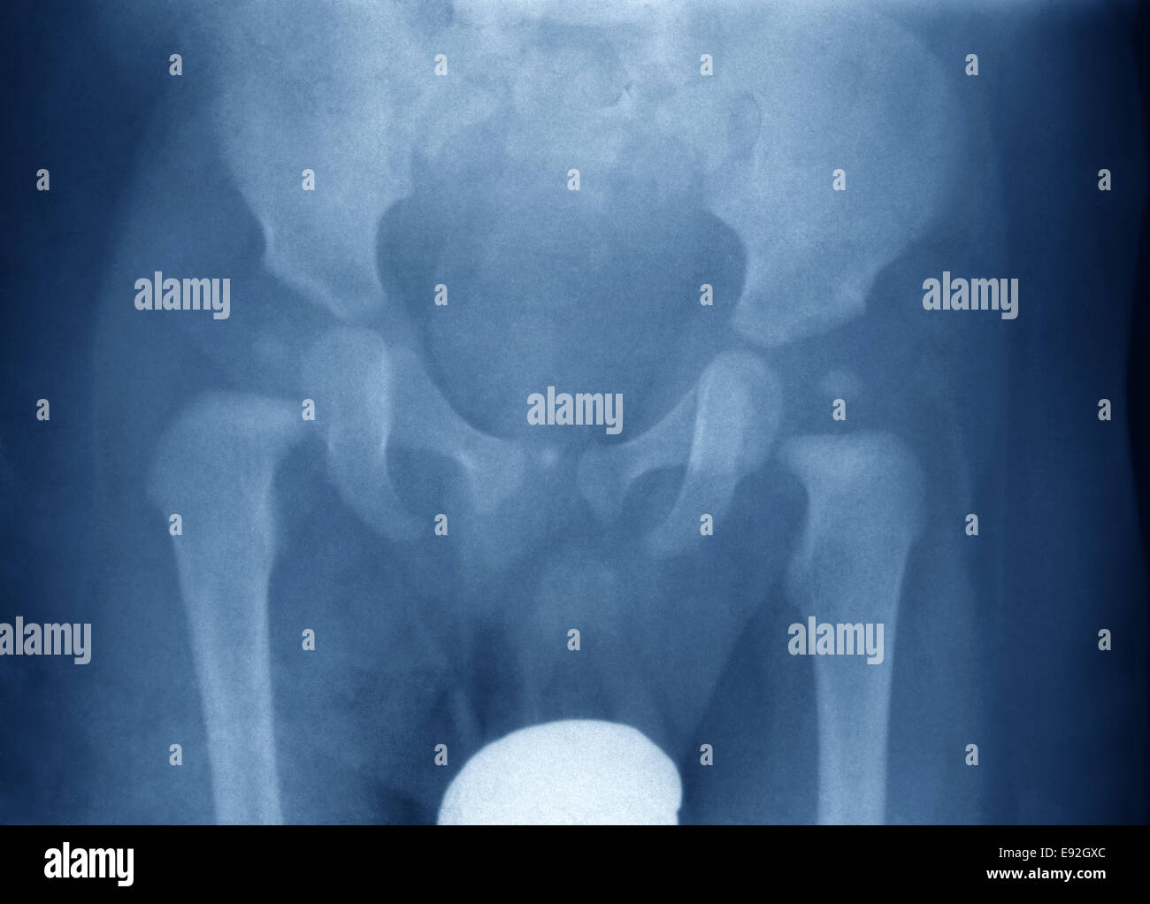 Röntgenaufnahme des Beckens und beide Hüften eines kleinen Jungen Stockfoto