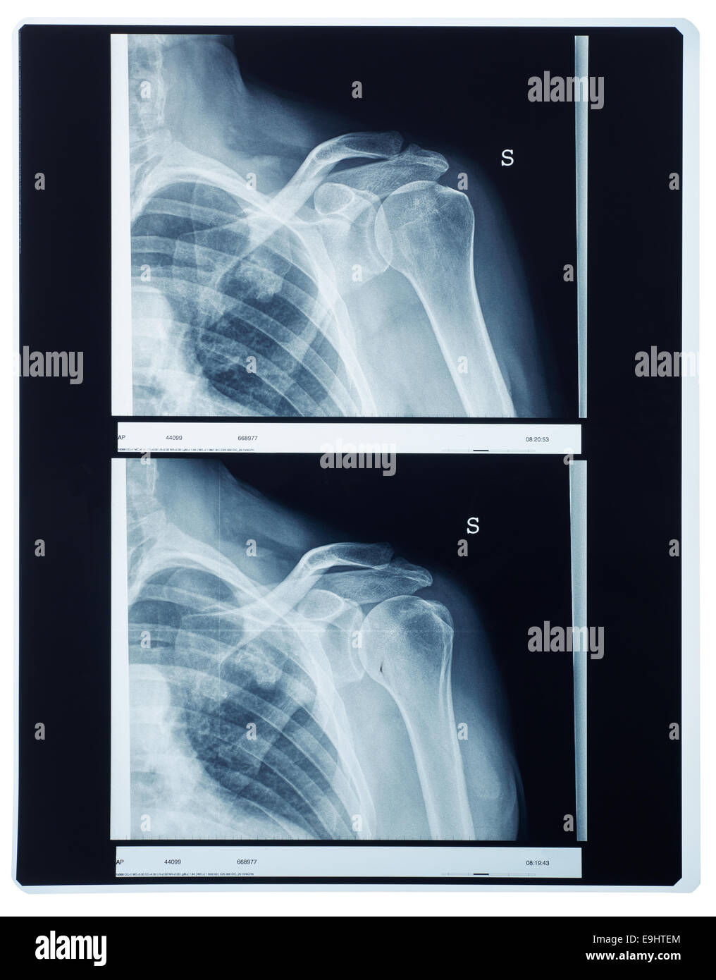 Röntgenbild Schulter Röntgen Stockfoto