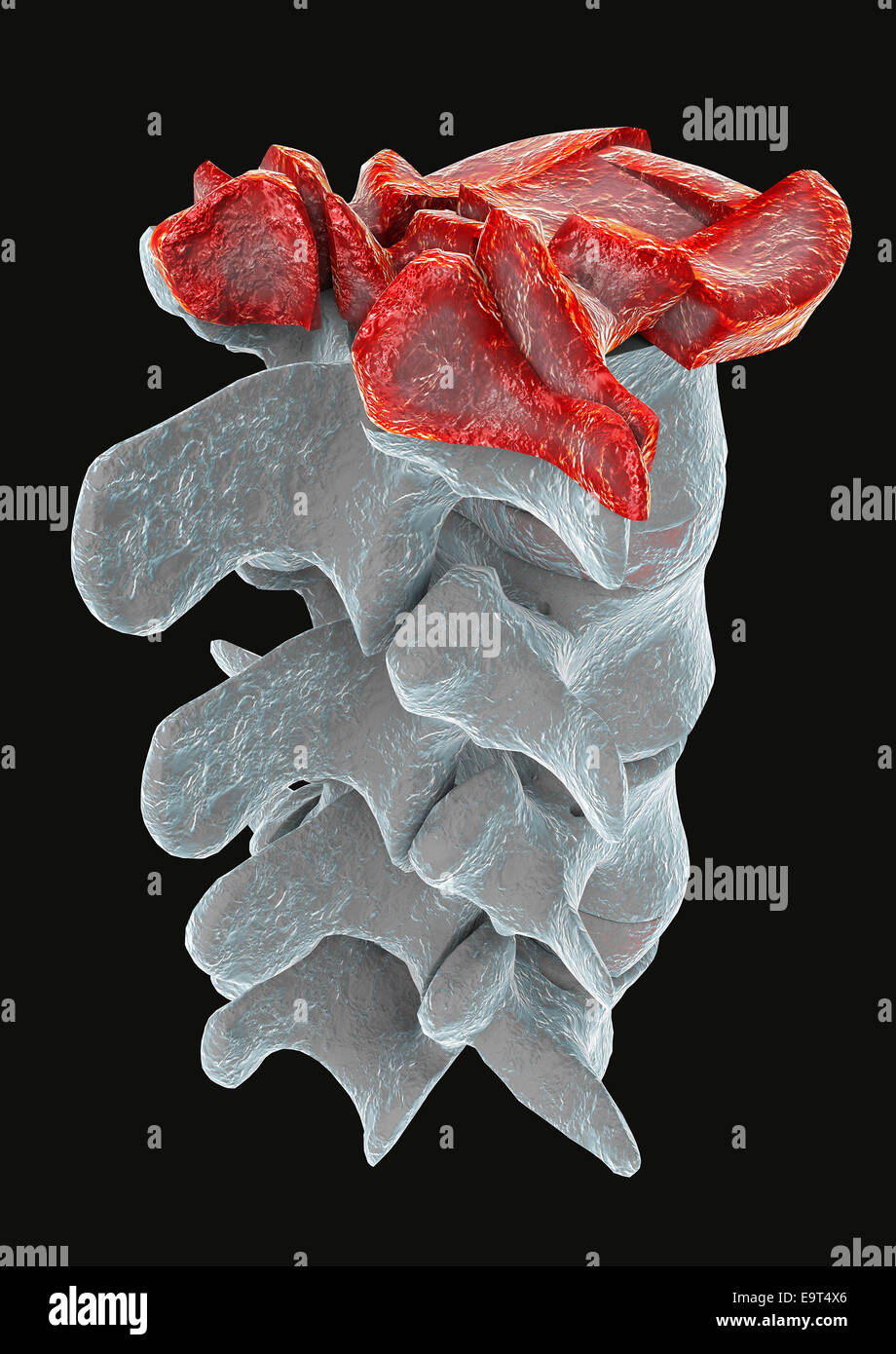 3D Abbildung eines Teils der menschlichen Wirbelsäule, traumatische Wirbelfraktur platzen Fraktur Stockfoto