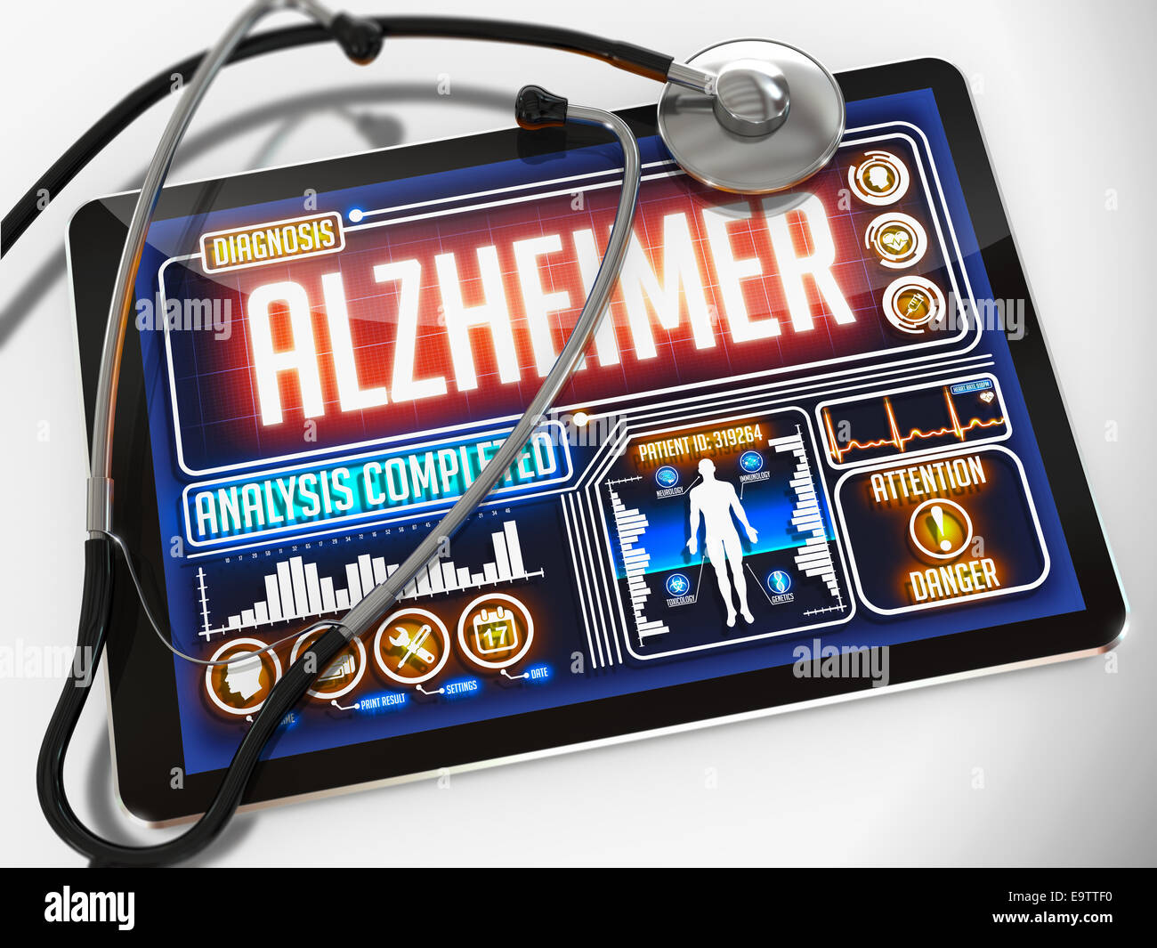 Medizinische Tablet mit der Diagnose von Alzheimer auf dem Display und einem schwarzen Stethoskop auf weißem Hintergrund. Stockfoto