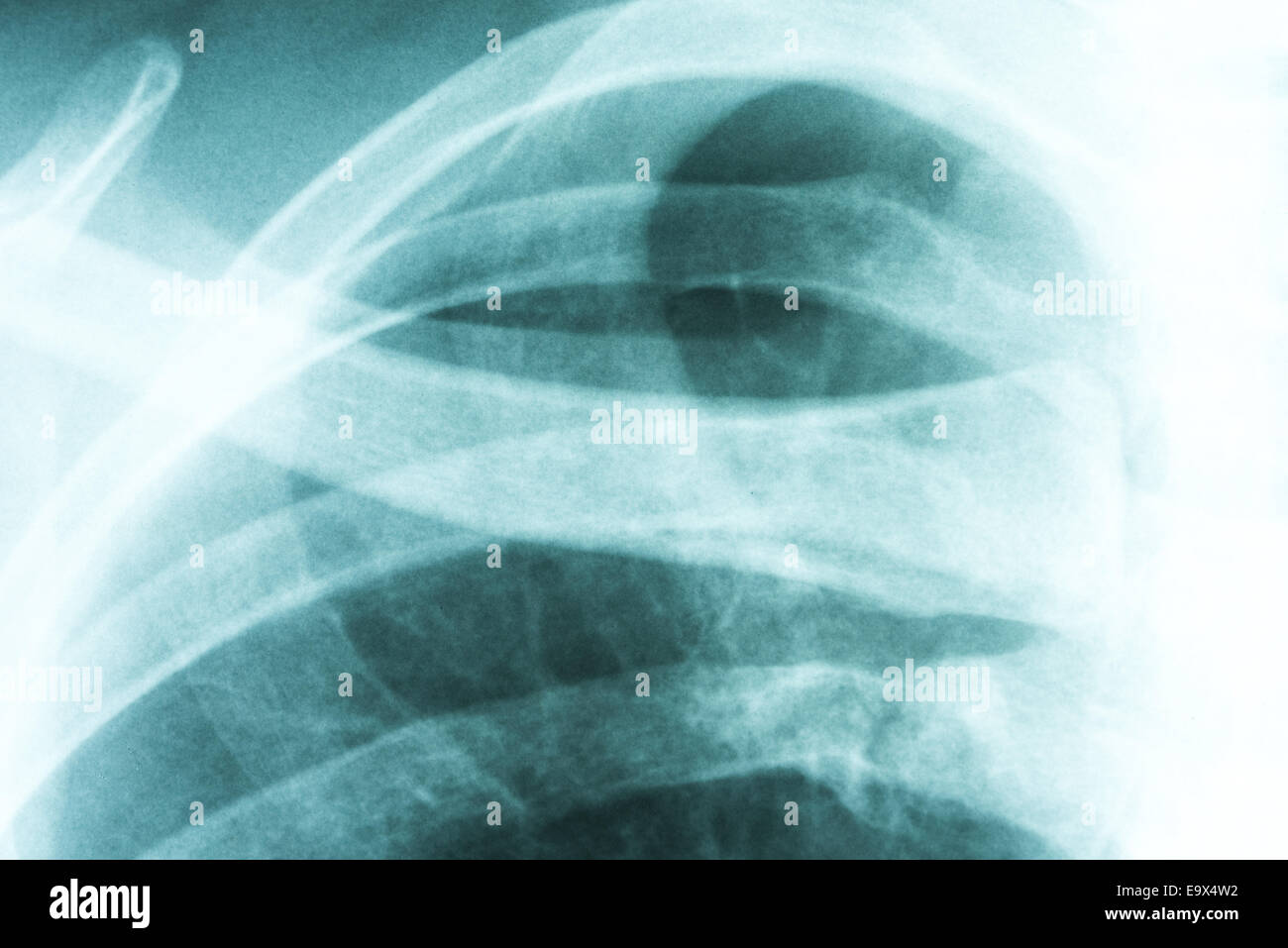 Medizinische Röntgen des menschlichen Schlüsselbeins Stockfoto