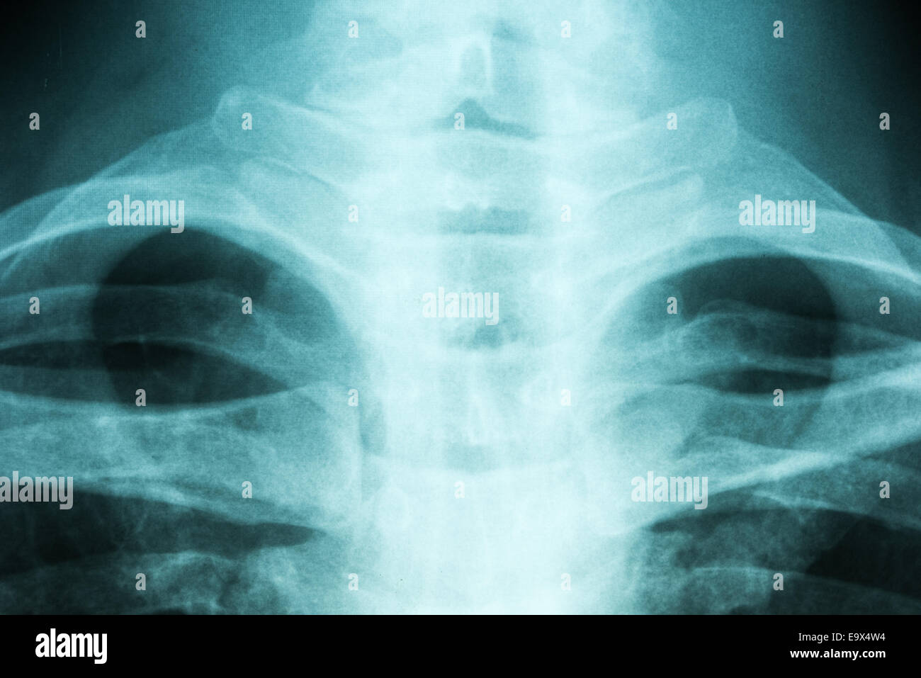Medizinische Röntgen des Thorax Wirbelsäule Stockfoto