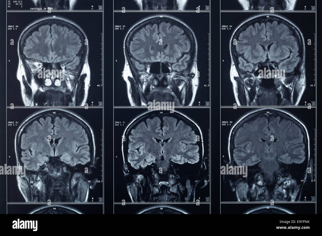 X-ray Kopf und Gehirn Radiographie Stockfoto