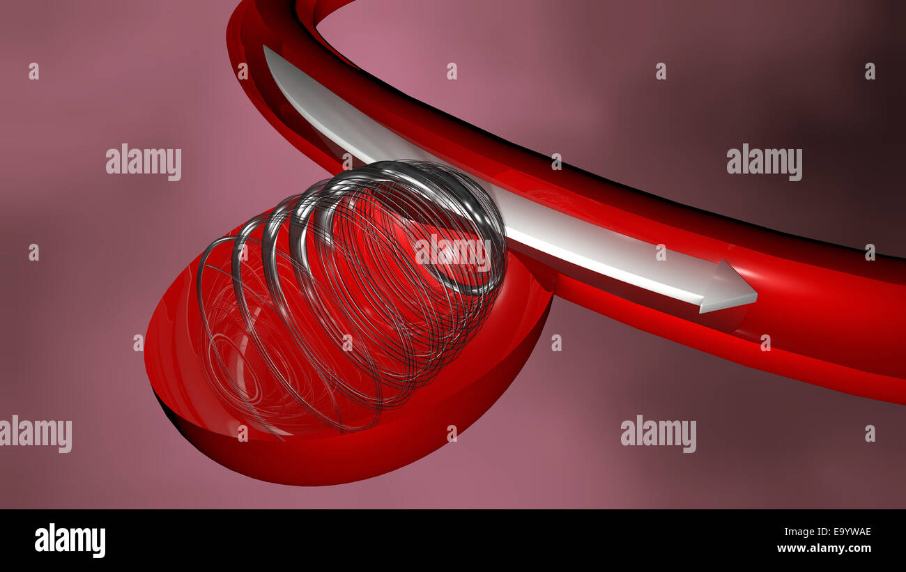 Aneurysma und endovaskuläre Behandlung, Spirale Stockfoto