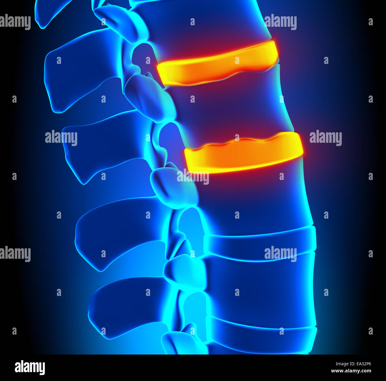 Osteophyt Bildung Bandscheibendegeneration - Wirbelsäulenproblem Stockfoto