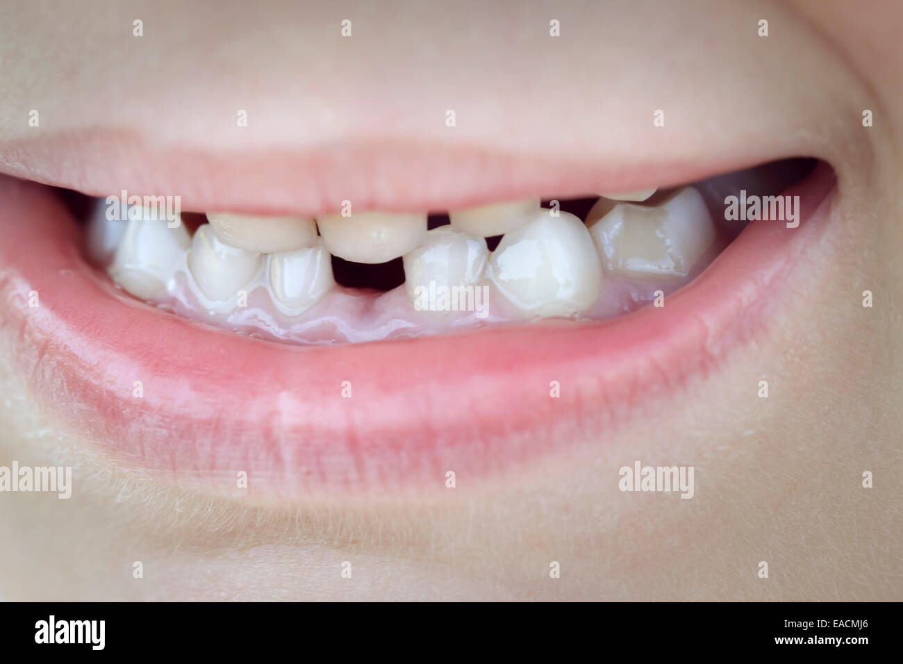 Zahn vermissten Kind Mund kaukasischen 6 Jahre jungen Stockfoto