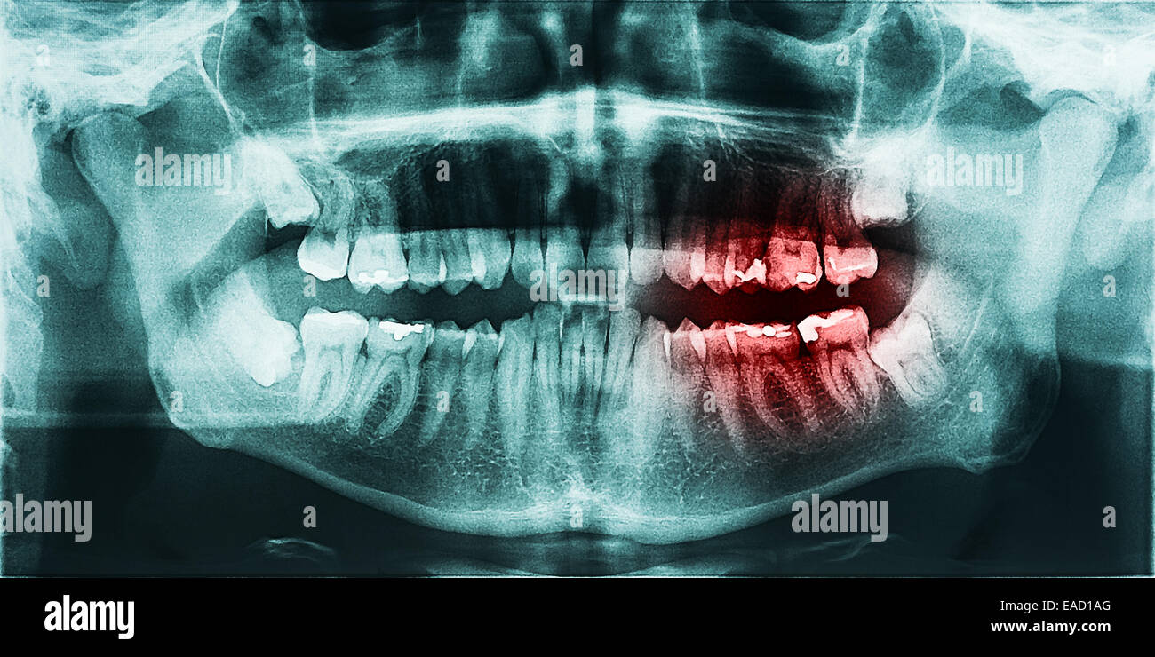 Verfallene Zahnschmerzen auf Röntgenbild Stockfotografie Alamy