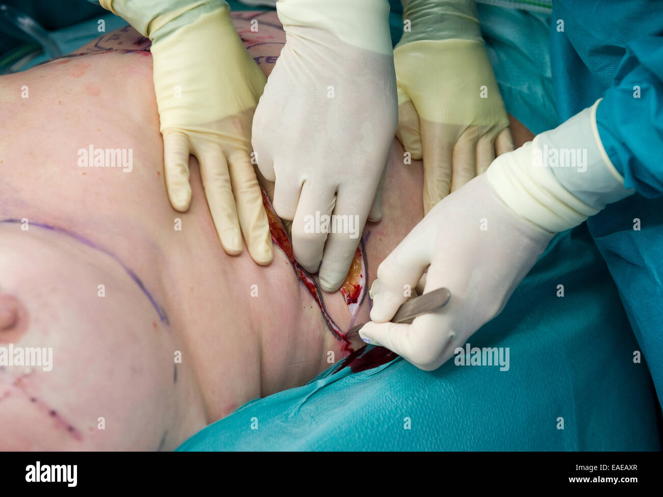 Chirurgen machen einem Einschnitt bevor sie Betrieb ein Patienten Stockfoto