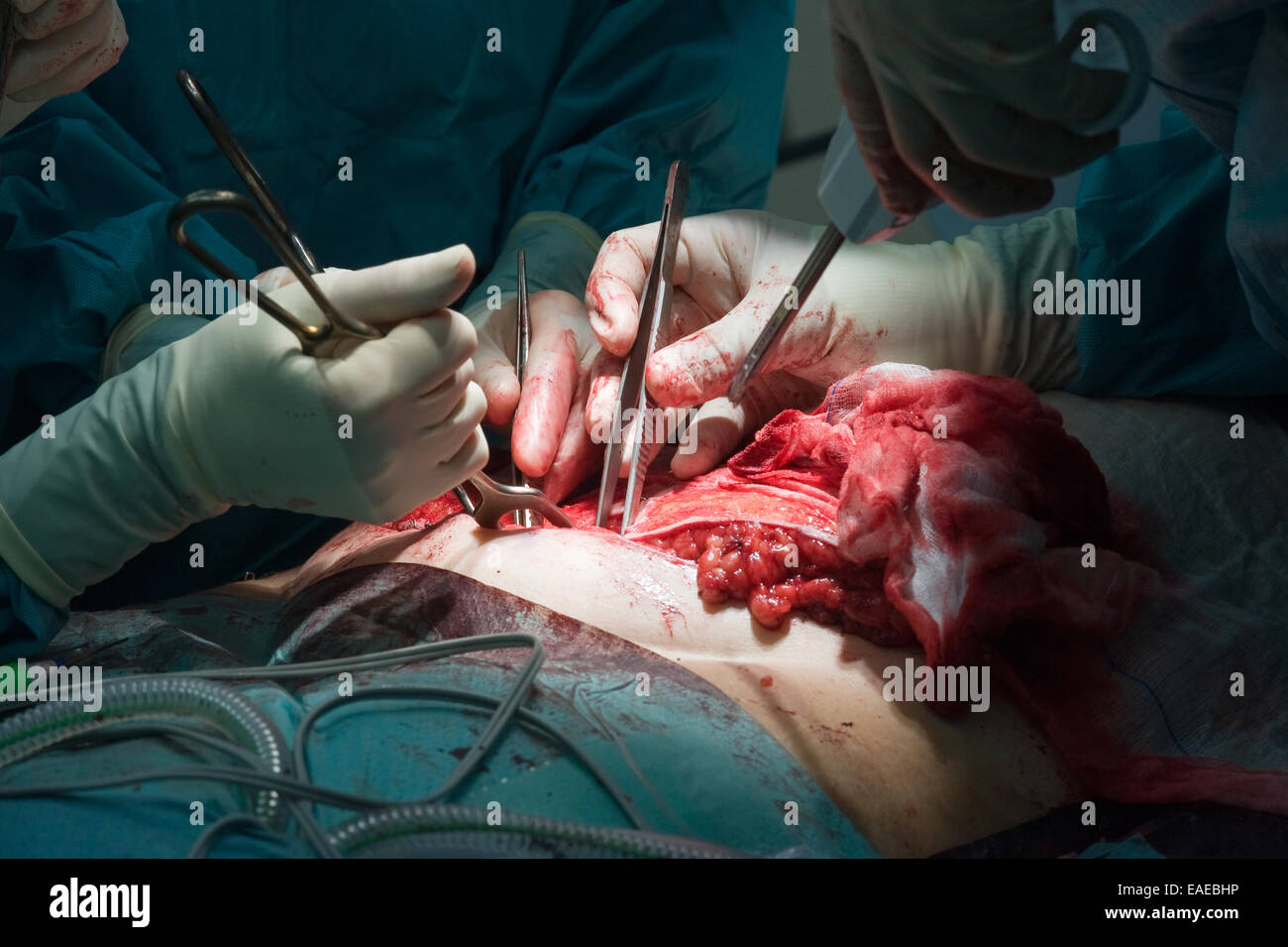 Ein Chirurg-Team arbeiten gemeinsam an einem Patienten während einer Operation in einem Krankenhaus Stockfoto