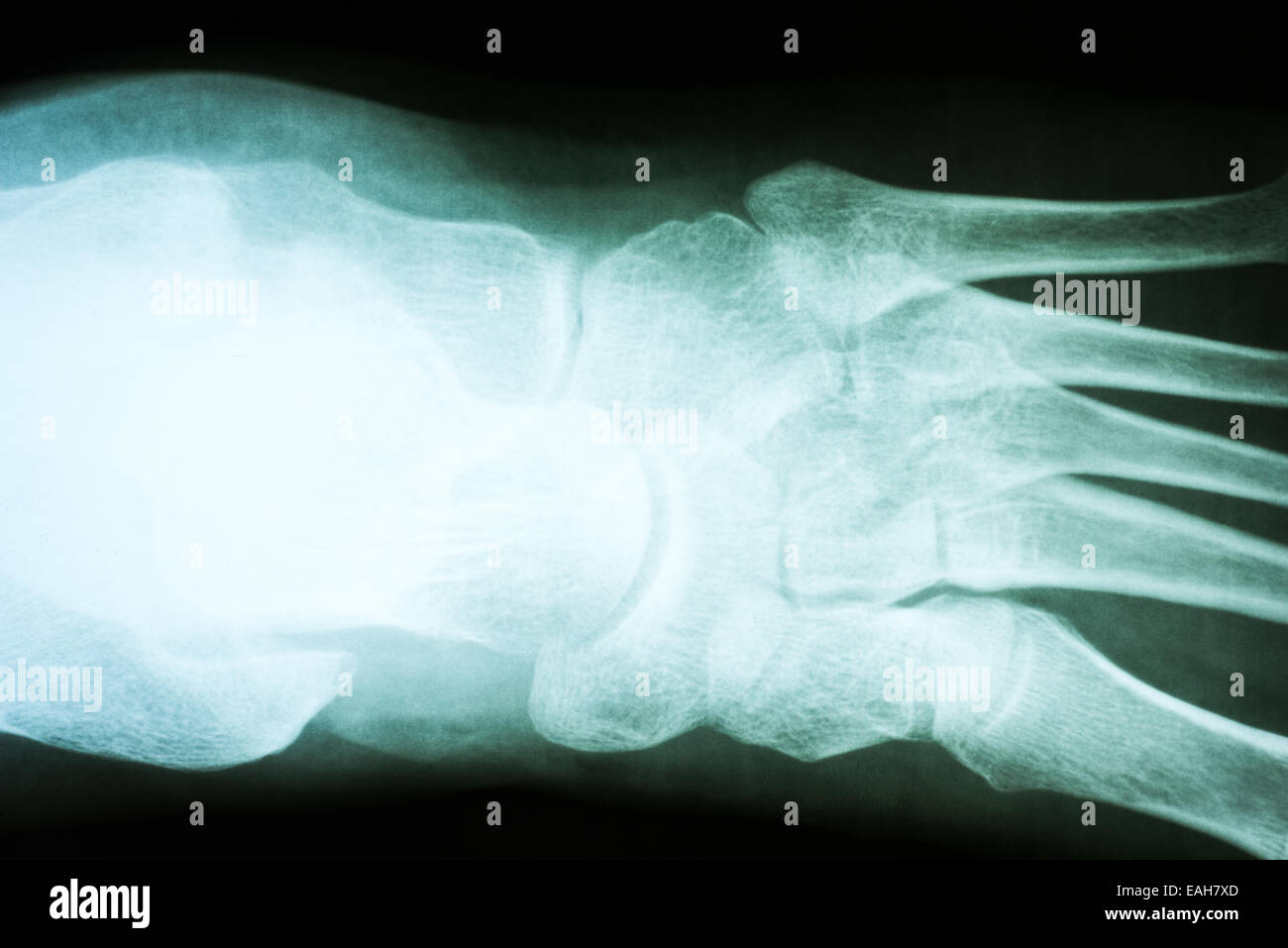 Menschlicher Fuß Röntgen auf schwarzem Hintergrund Stockfoto
