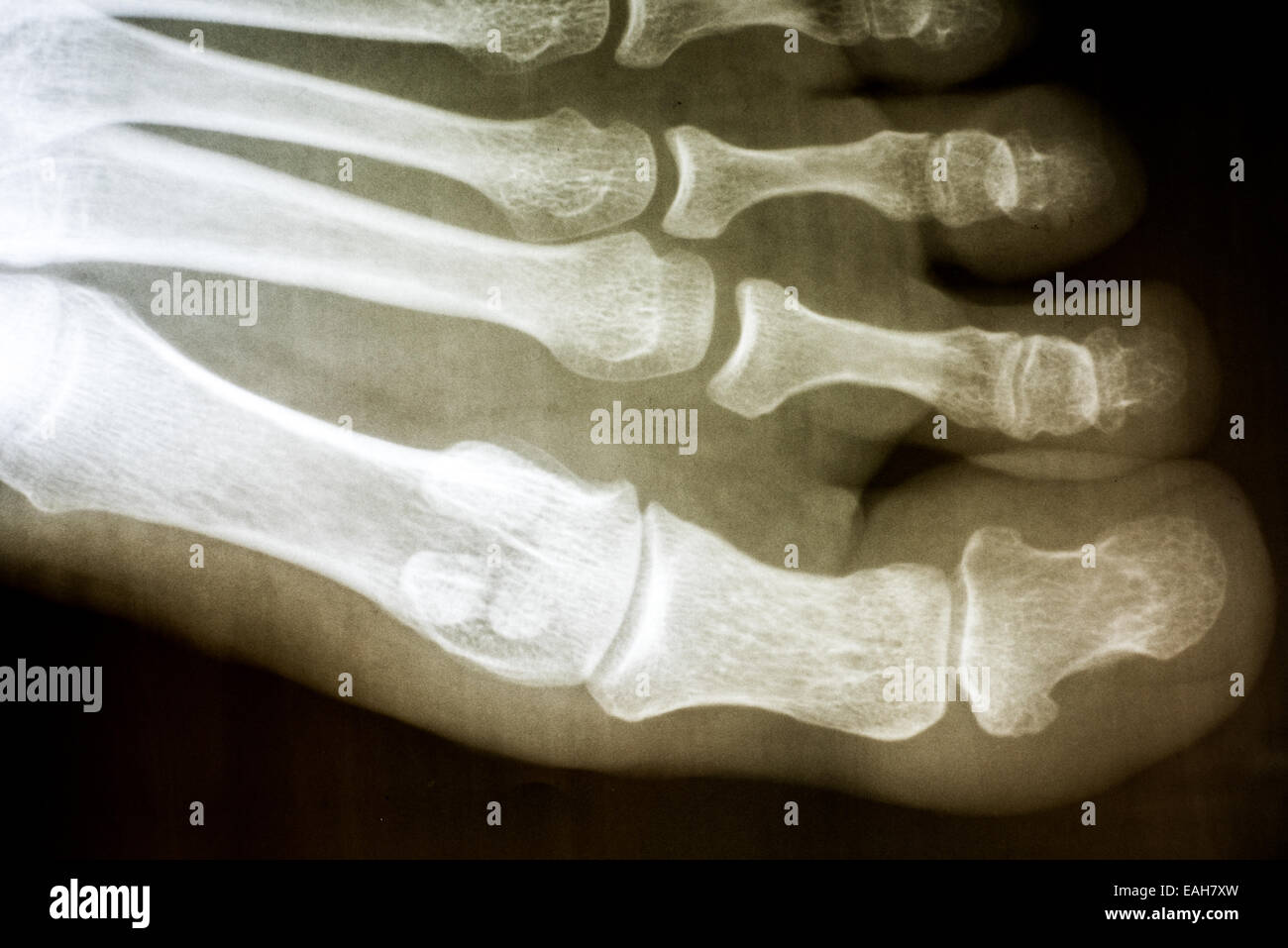 Menschlicher Fuß Röntgen auf schwarzem Hintergrund Stockfoto