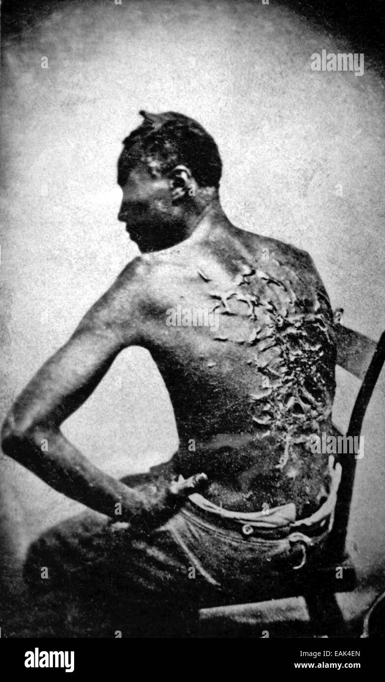 Sklaverei A Mississippi Sklave namens Peter oder Gordon zeigt seine Narben in Baton Rouge am 2. April 1863. Siehe Beschreibung unten Stockfoto