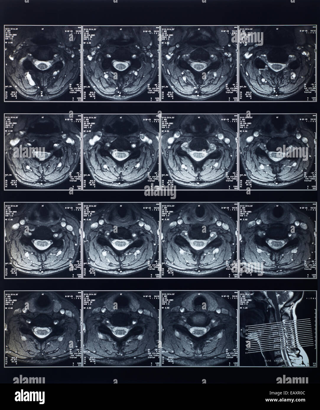 Röntgen Wirbelsäule Röntgen Stockfoto