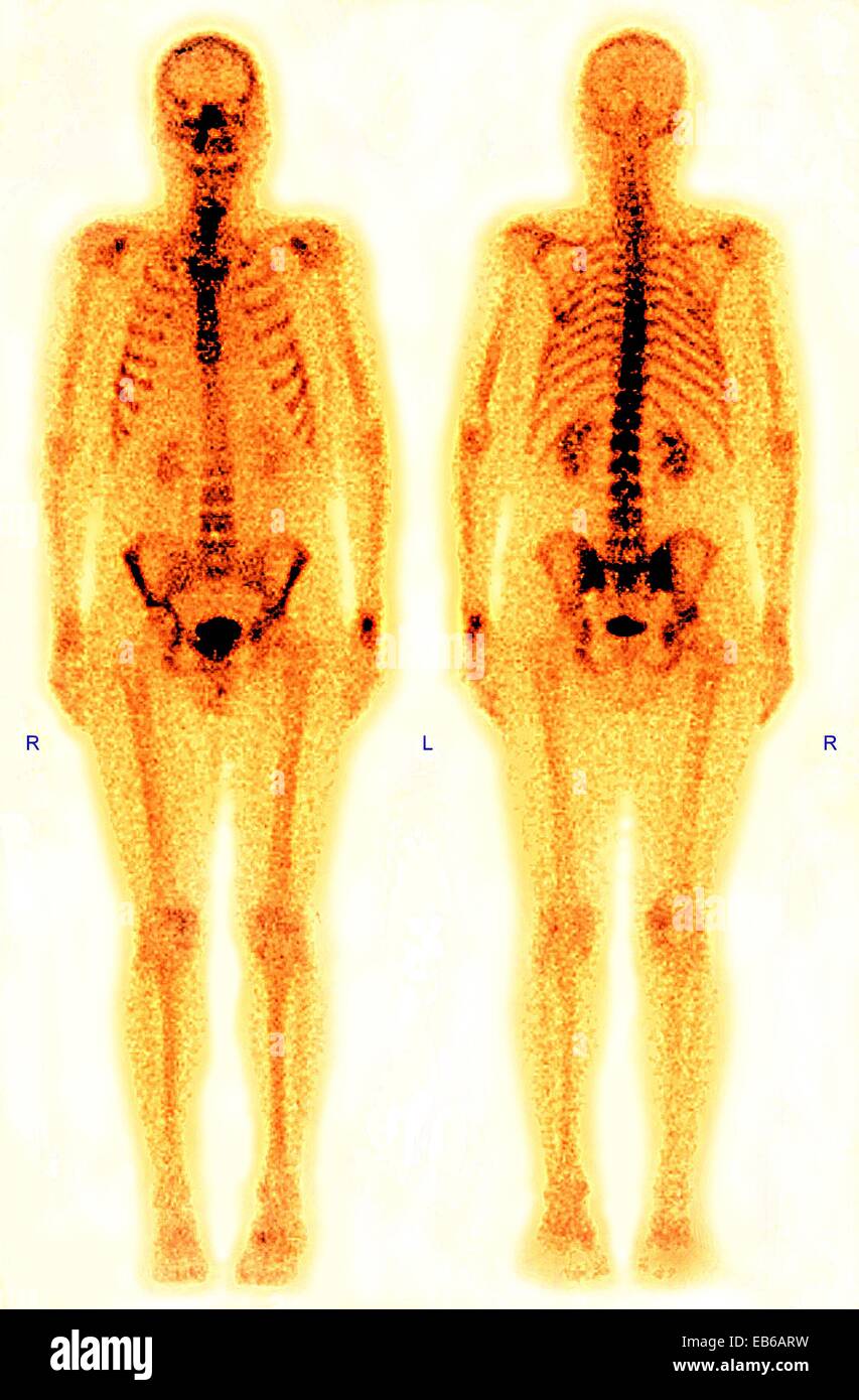 GANZKÖRPER-SCINTISCANNER Stockfoto