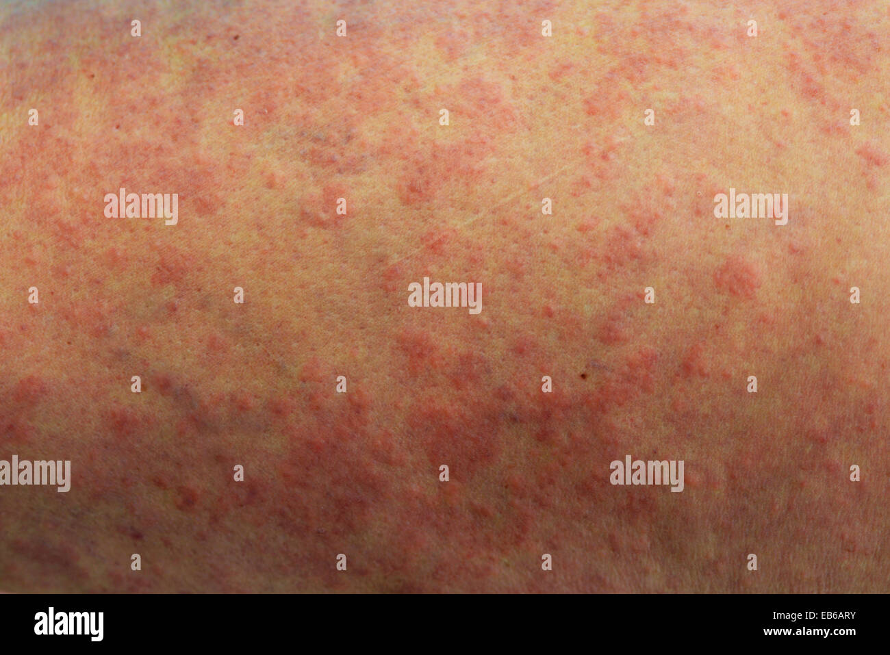 Erythema Stockfotos &amp; Erythema Bilder Alamy