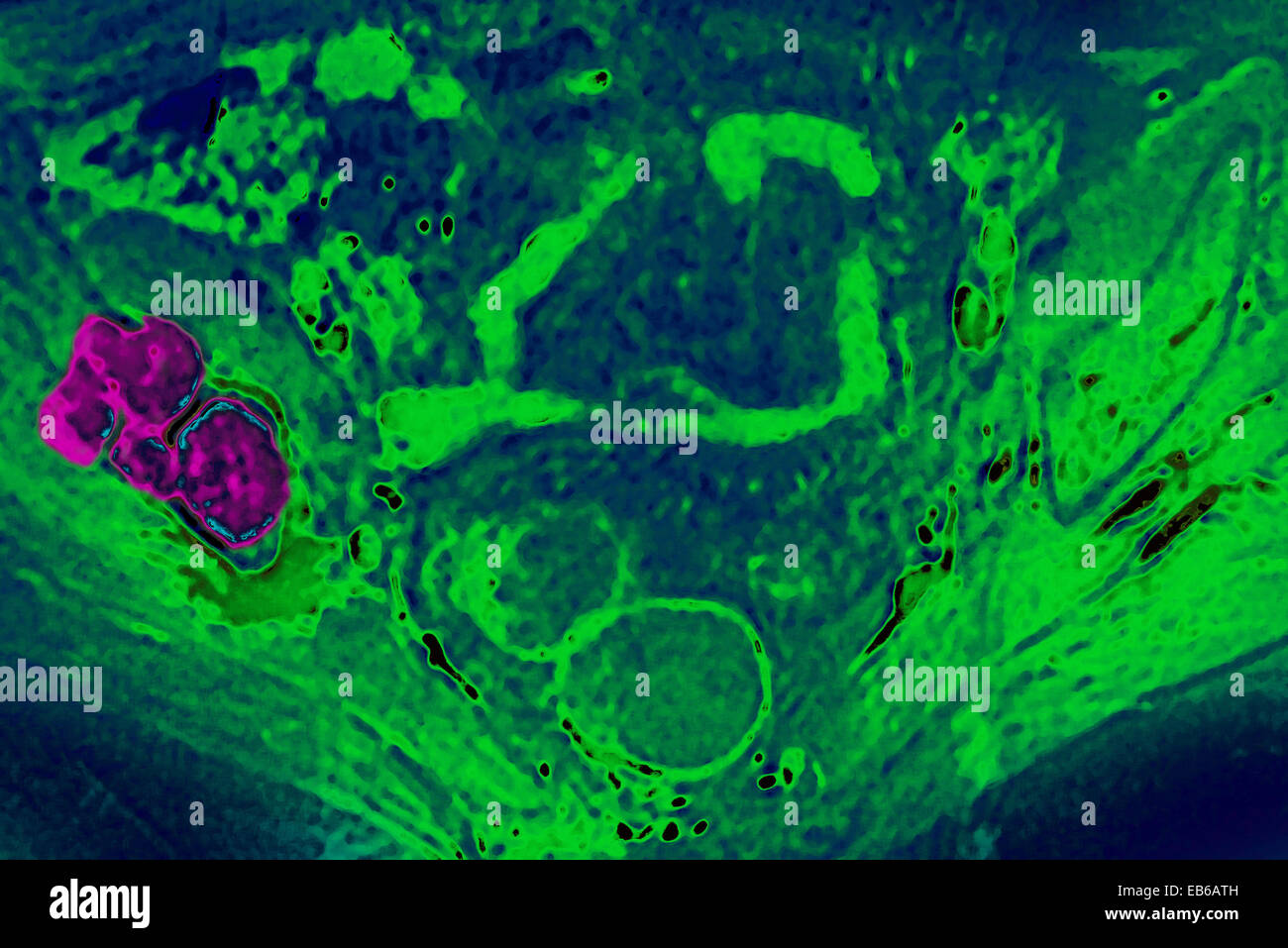 KNOCHEN-KREBS, CT-SCAN Stockfoto