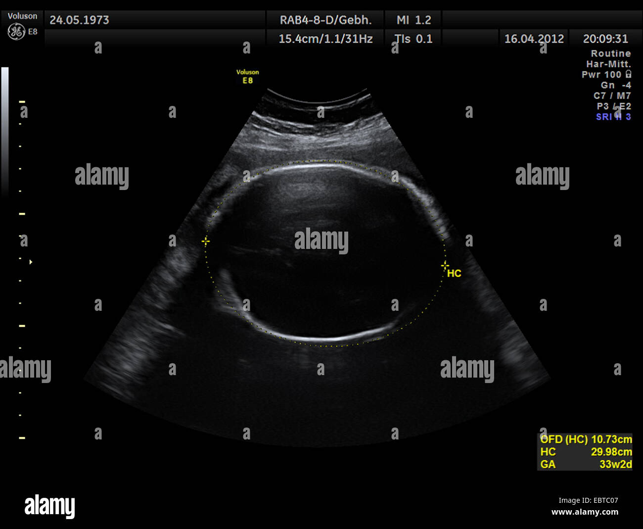 Ultraschalluntersuchung des Kopfes eines Embryos in der Gebärmutter Stockfoto