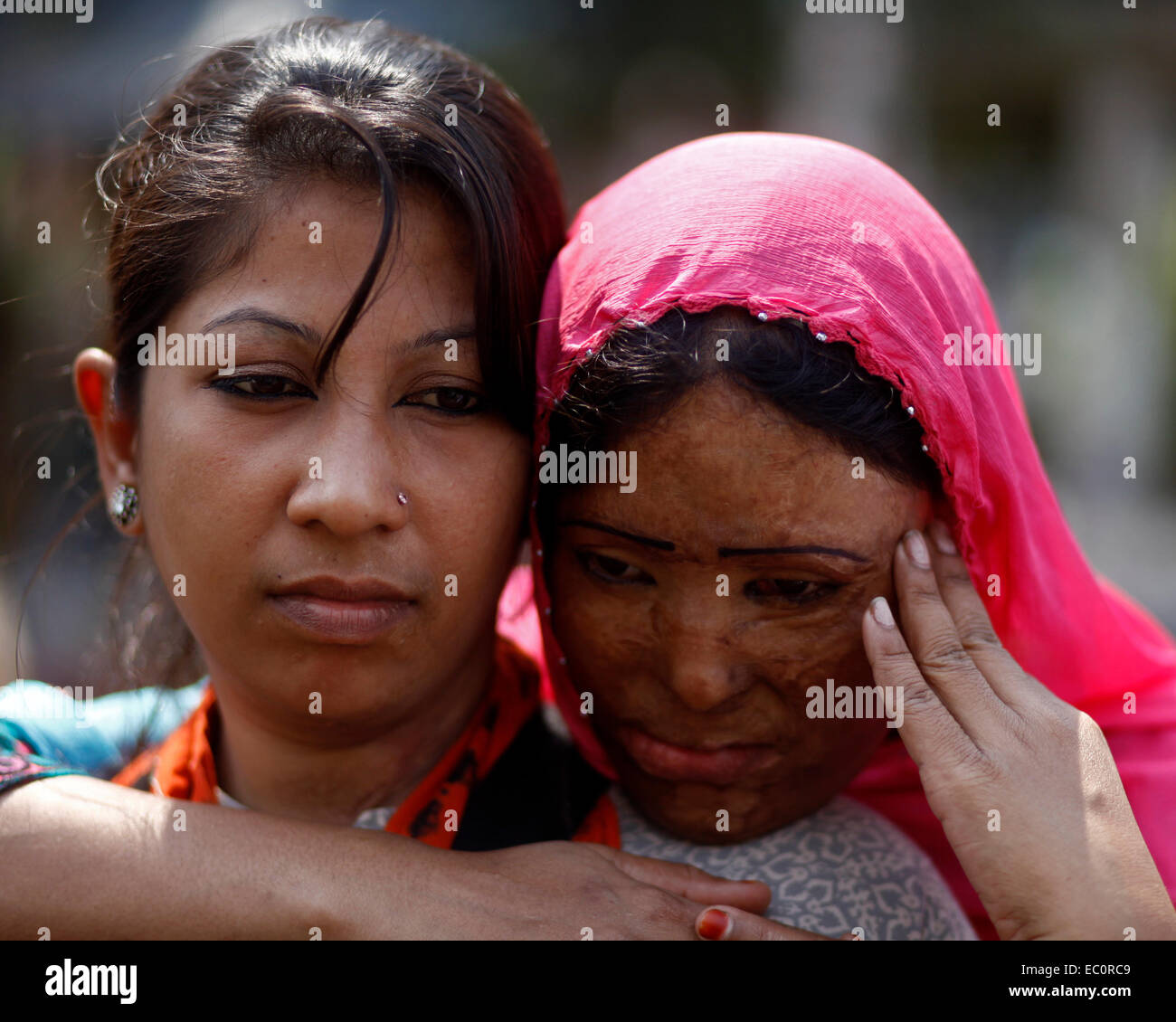 Dhaka, Bangladesch, 7. März 2014: Überlebende der Säureattacken, besuchen eine Menschenkette gegen sauren Gewalt am Vorabend der Feier der Internationale Frauentag in Dhaka, Bangladesch zu protestieren. Je nach Säure Überlebenden Foundation (ASF) gab 3.184 Säureattacken seit Februar 1999 bis Februar 2014 in Bangladesch, wo 1.792 Frauen Opfer unter insgesamt 3.512 waren. Säureattacken sind meist üblich, in Kambodscha, Pakistan, Afghanistan, Indien, Bangladesch und im nahen Ausland. Es wird geschätzt, dass rund 80 Prozent der Opfer von Säureattacken weiblich sind und 40 Prozent von ihnen sind Stockfoto
