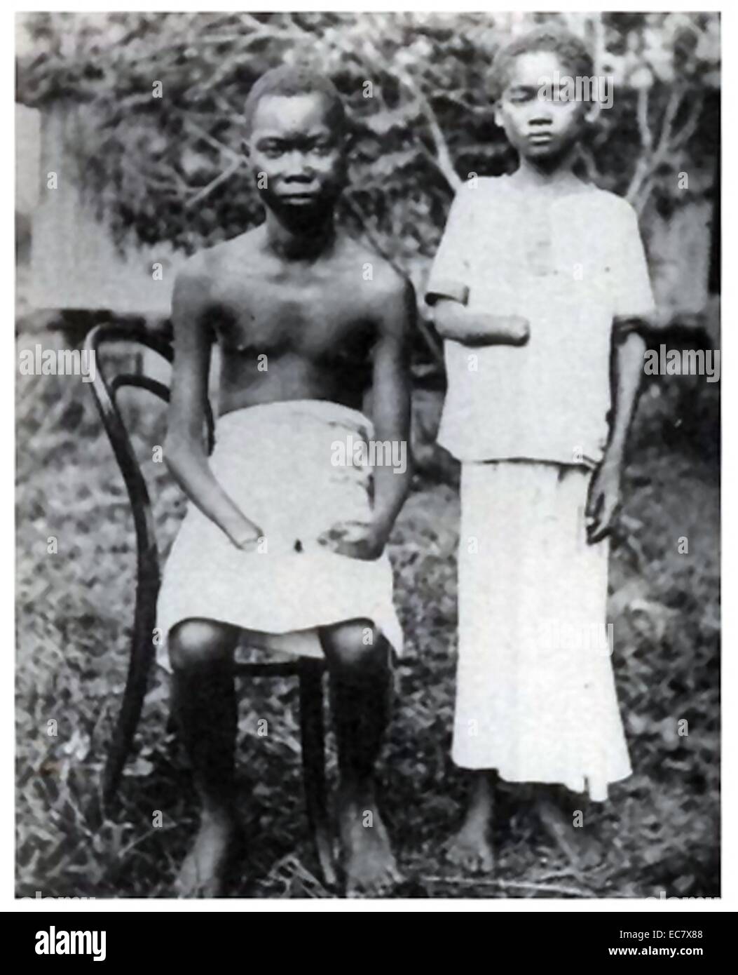 Amputation wurde häufig verwendet, um Arbeiter in den Kongo-Freistaat zu bestrafen;   gesteuert durch Leopold II von Belgien 1900 Stockfoto