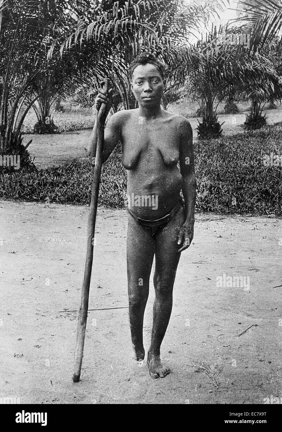 Amputation wurde häufig verwendet, um Arbeiter in den Kongo-Freistaat zu bestrafen;   gesteuert durch Leopold II von Belgien 1900 Stockfoto