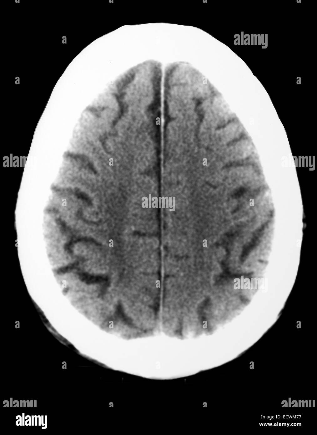 CT-Scan zeigt Atrophie der beiden Gehirnhälften Stockfoto