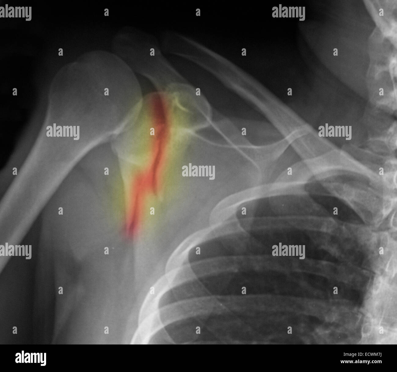 Schulter Röntgen zeigt gebrochenen Schulterblatt (Scapula). Stockfoto