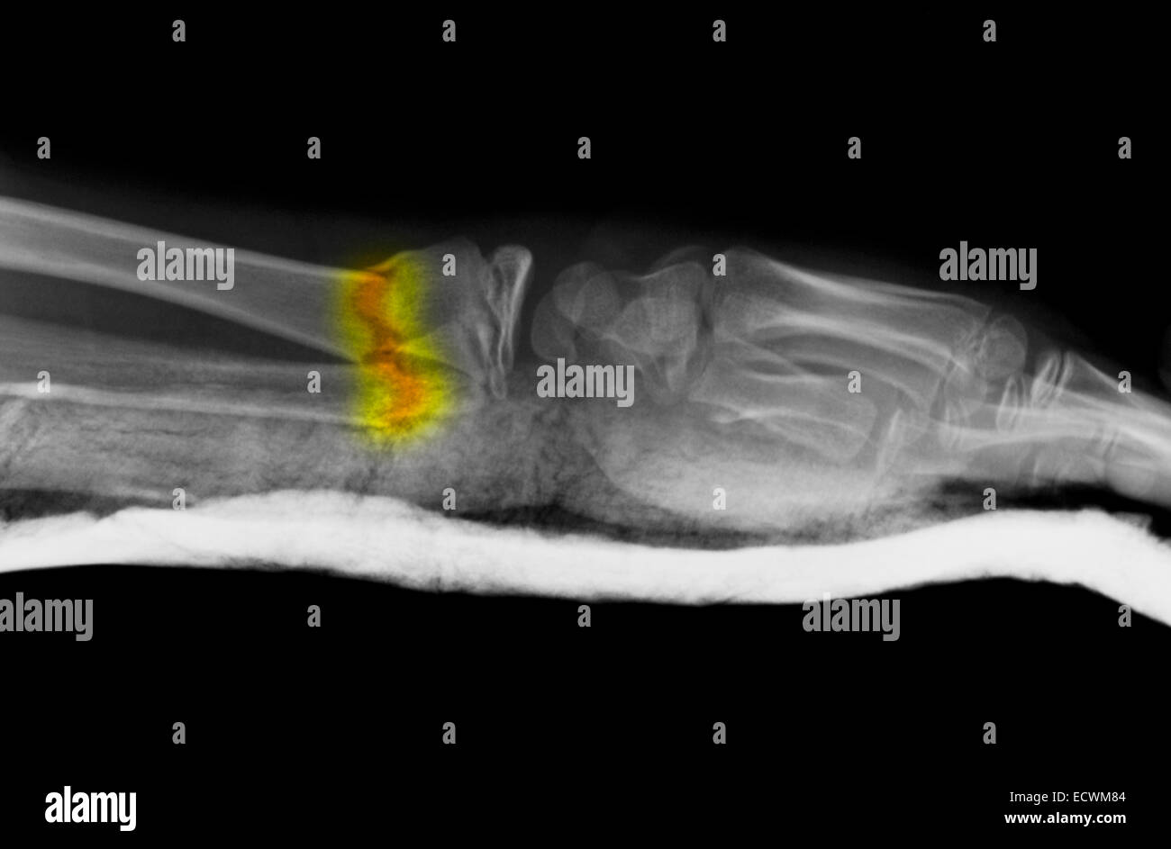 Röntgenbild des Unterarmes zeigen eine Fraktur. Stockfoto