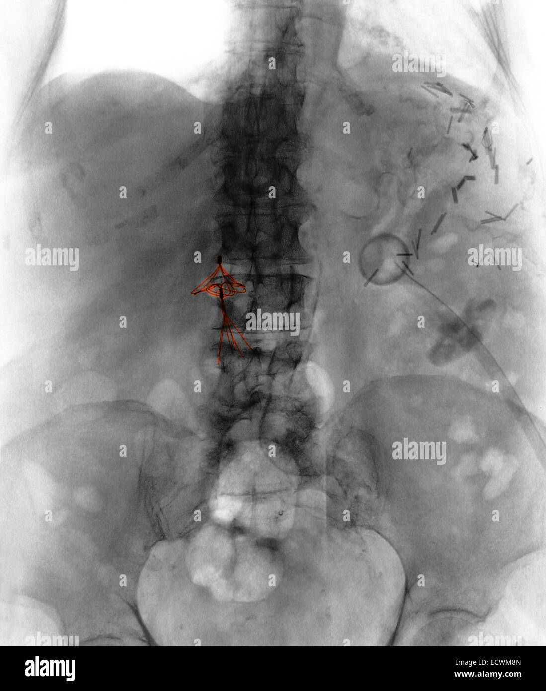 Bauch x-ray zeigt einen Vena Cava Blutgerinnsel Filter. Stockfoto