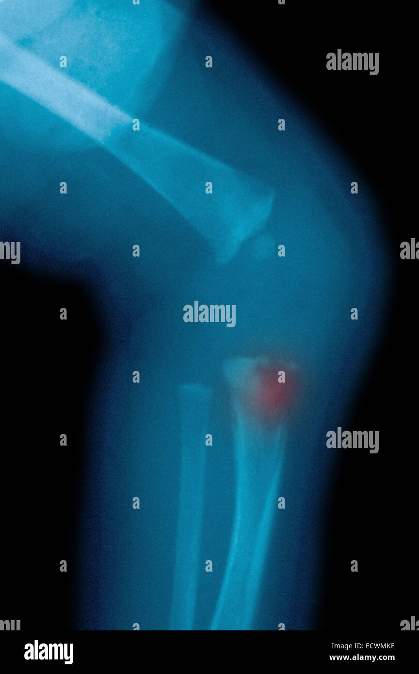 x-ray zeigt Knochen Anomalien in angeborenen Syphilis gesehen. Stockfoto