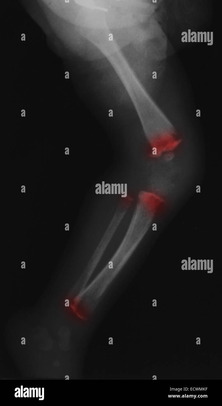x-ray zeigt Knochen Anomalien in angeborenen Syphilis gesehen. Stockfoto