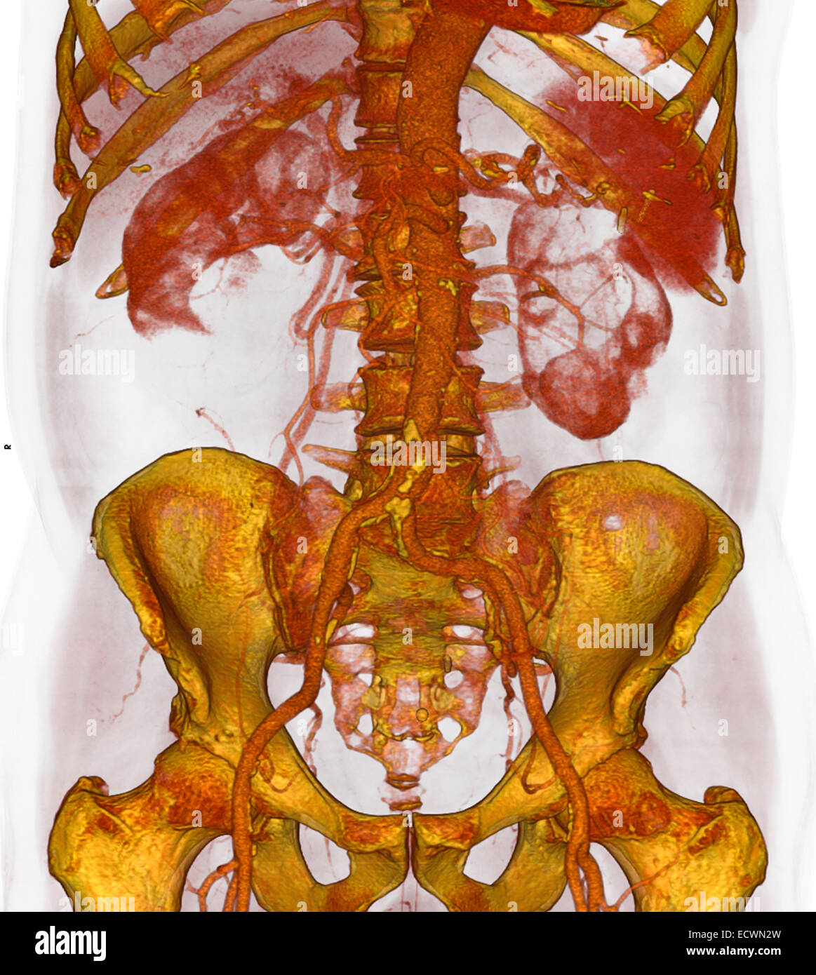3D CT zeigt atherosklerotischen Plaques auf der unteren Aorta. Stockfoto