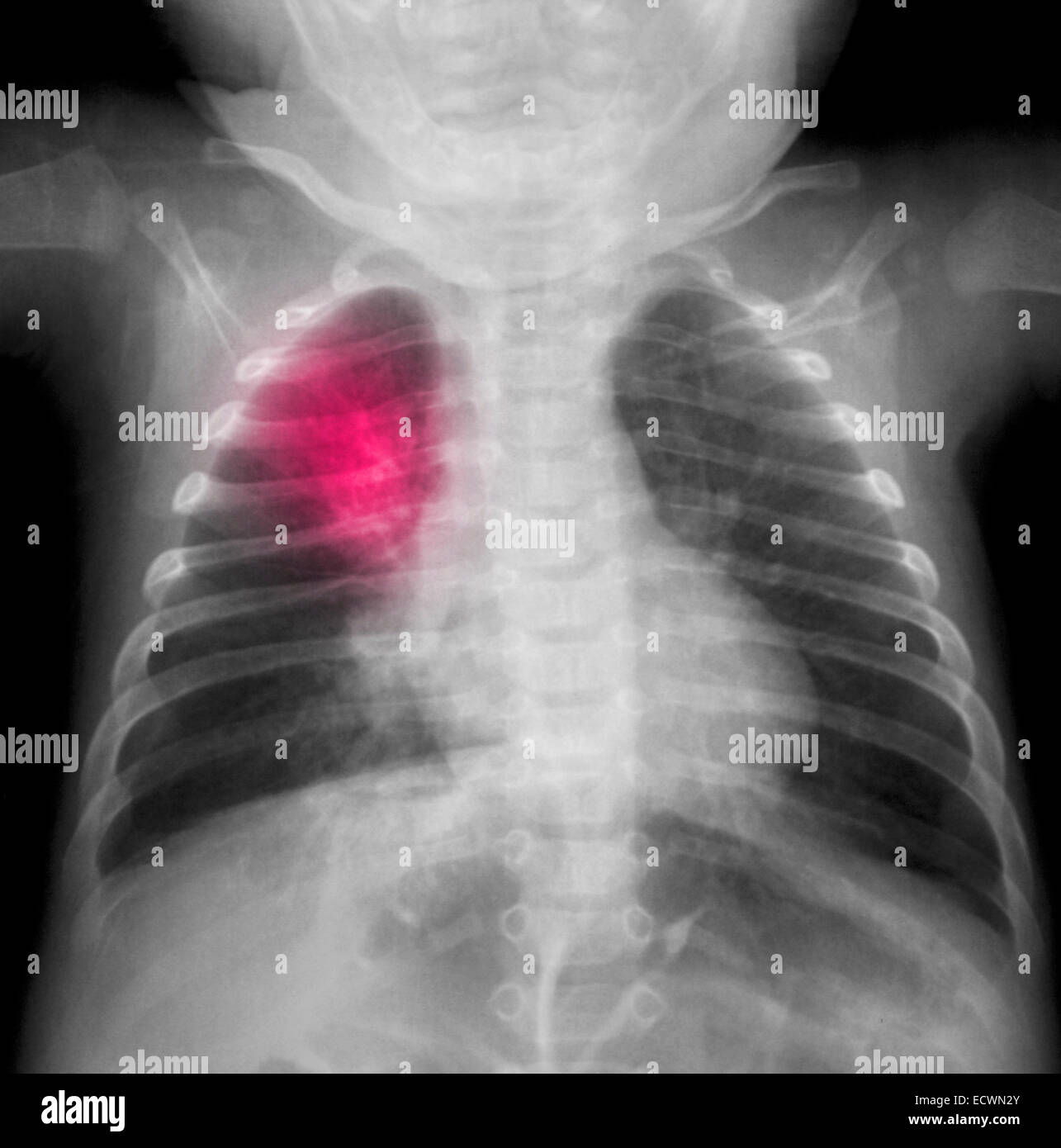 Röntgenaufnahme eines 3 Monate alten Jungen mit einer Lungenentzündung. Stockfoto
