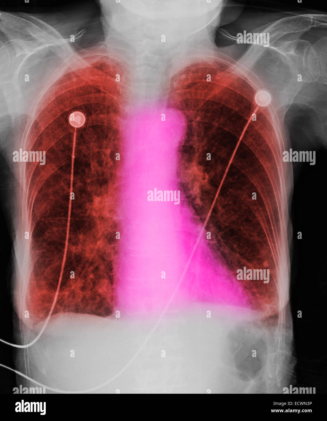 Röntgen-Thorax zeigt chronischen obstruktiven Lungenerkrankung. Stockfoto