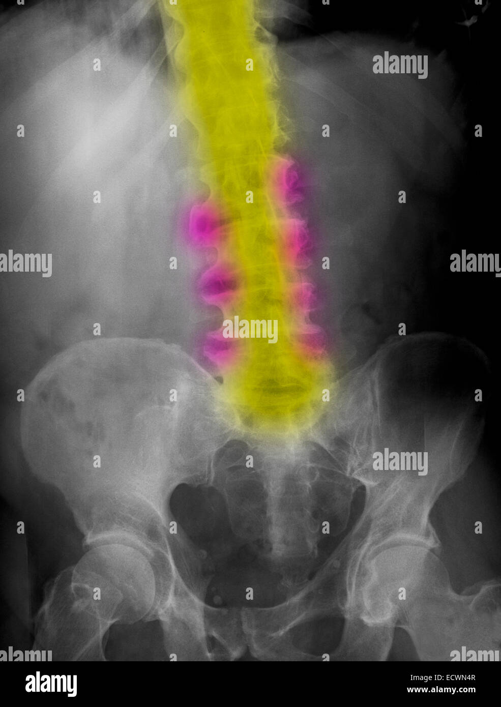 Lendenwirbelsäule Röntgenbild zeigt Arthrose und Knochen Sporen Stockfoto