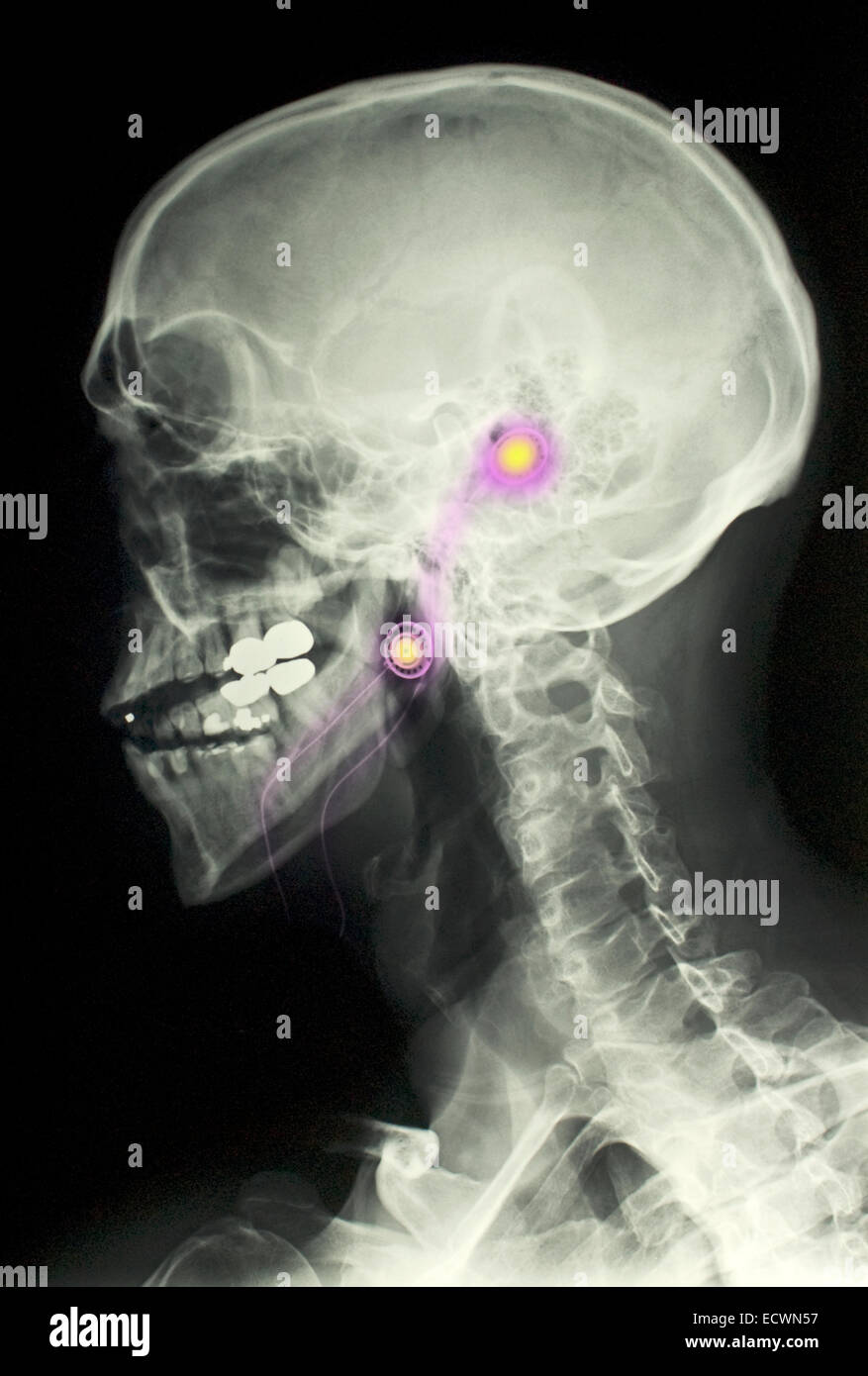 Röntgen des Kopfes eines Mannes mit iPod Ohrhörer. Stockfoto