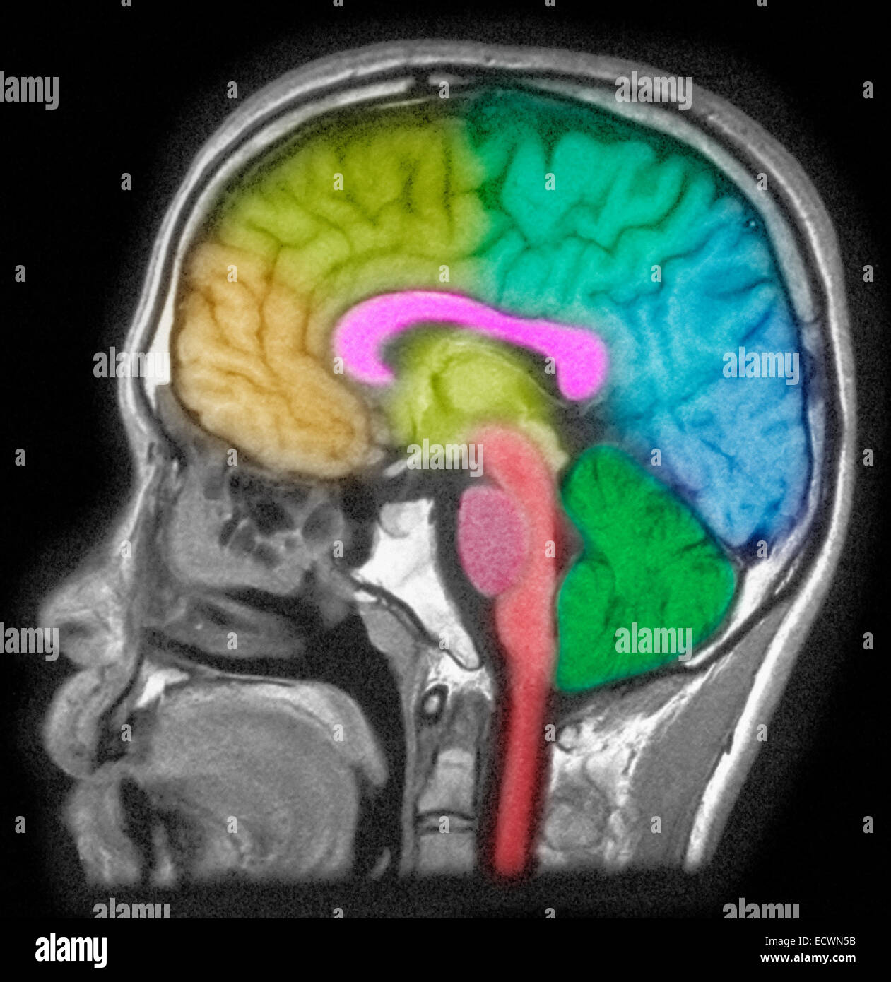 MRI des Kopfes zeigt Hirnstrukturen. Stockfoto