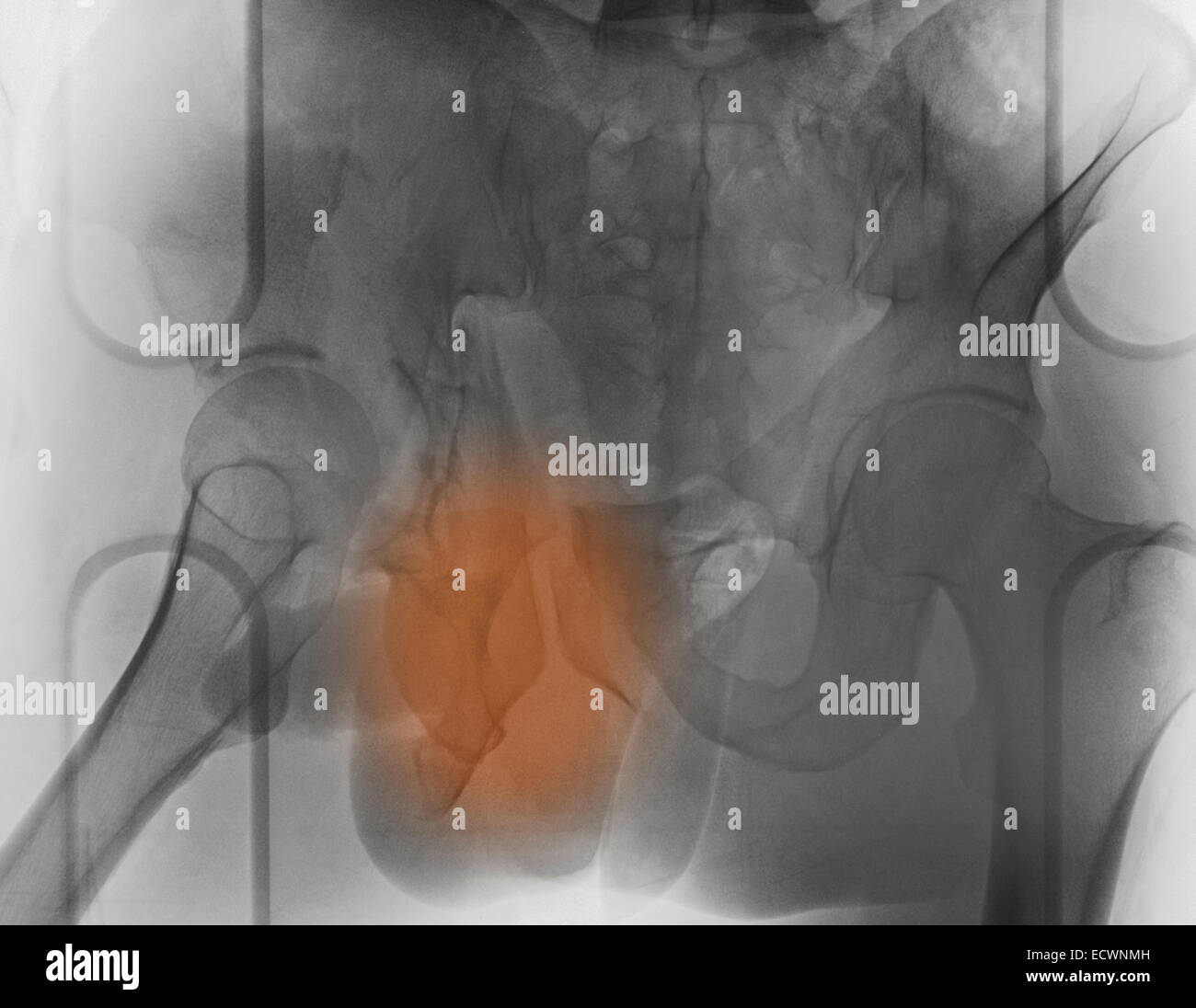 X-ray ein 30 Jahre alter Mann mit einer Beckenfraktur. Stockfoto
