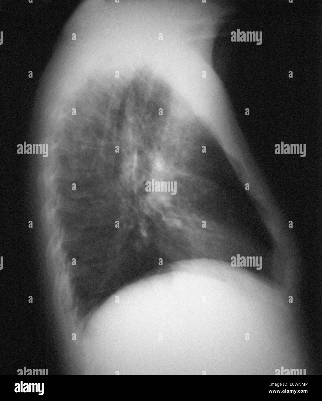 Pneumocystis carinii Fotos und Bildmaterial in hoher Auflösung Alamy