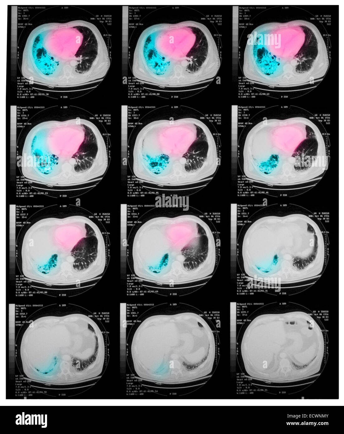 CT-Untersuchung der Brust mit einer Lungenentzündung. Stockfoto