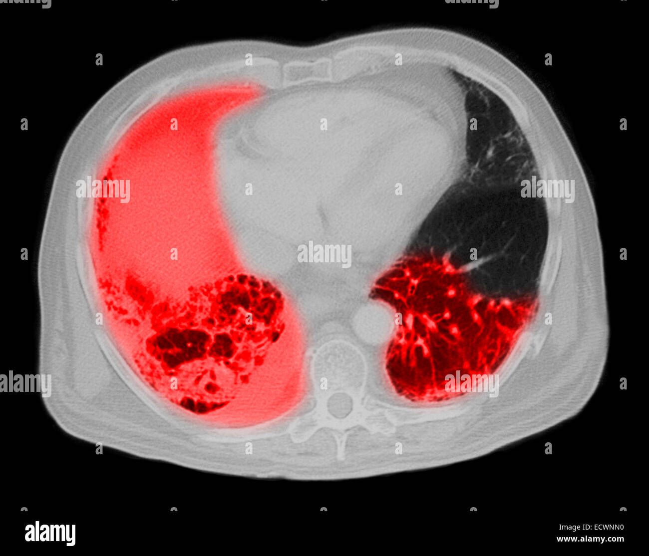 CT-Untersuchung der Brust mit einer Lungenentzündung. Stockfoto