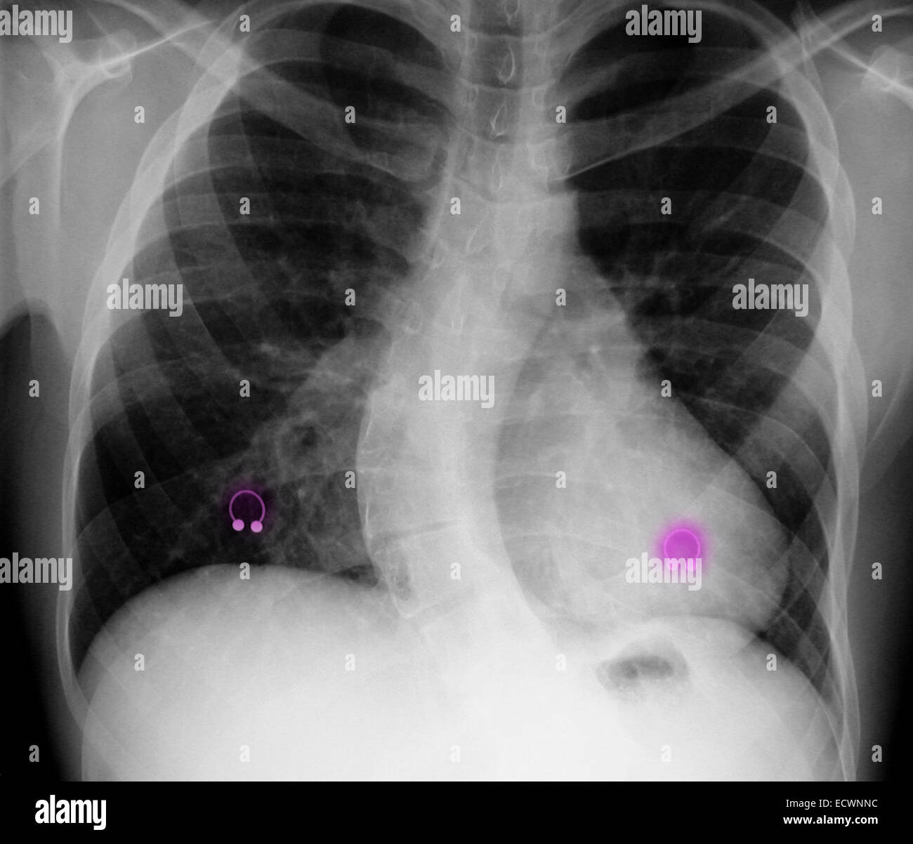 Brust Röntgen zeigt Skoliose und Nippel Piercings. Stockfoto