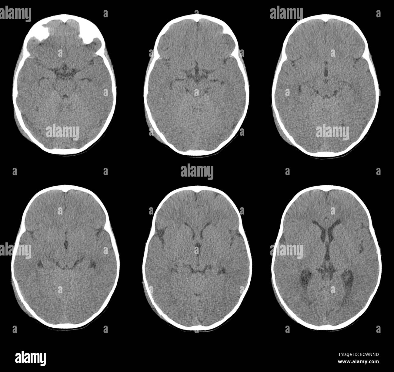 Kopf-CT zeigt einen Schädelbruch und eine subdurale Hämatom. Stockfoto
