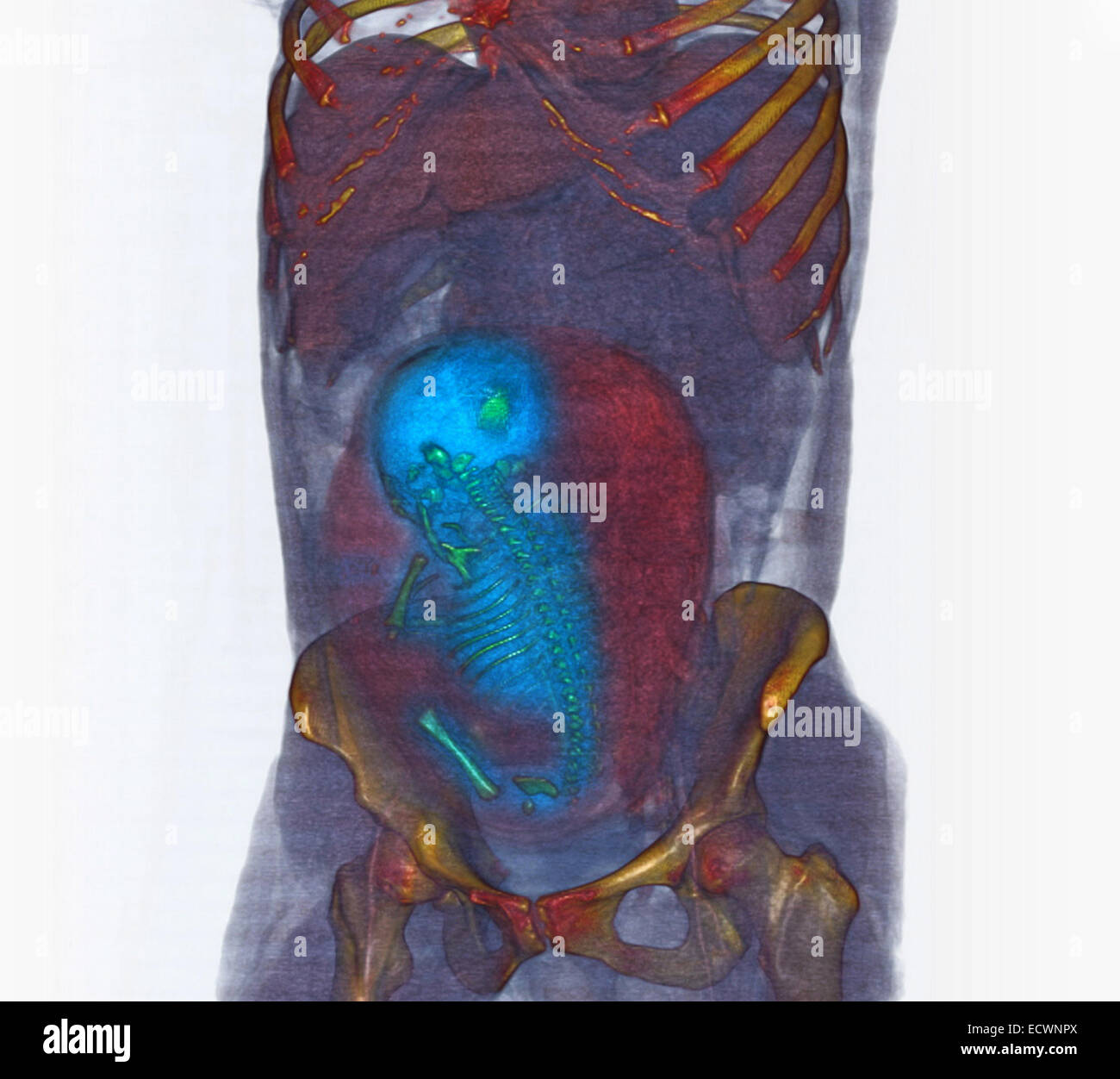 3D CT-Scan zeigt einen volle Amtszeit Fötus in Beckenendlage Stockfoto