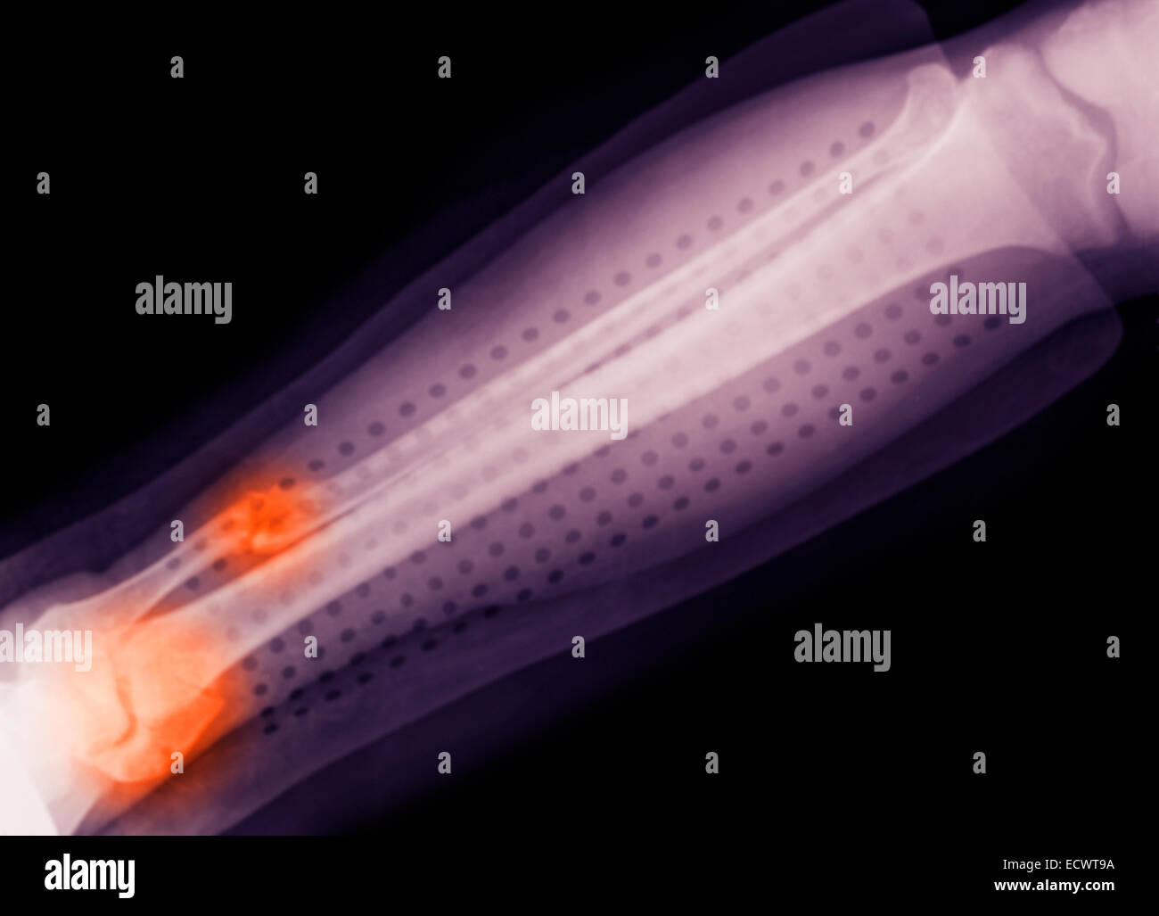 X-ray ein Sprunggelenk Fraktur. Stockfoto