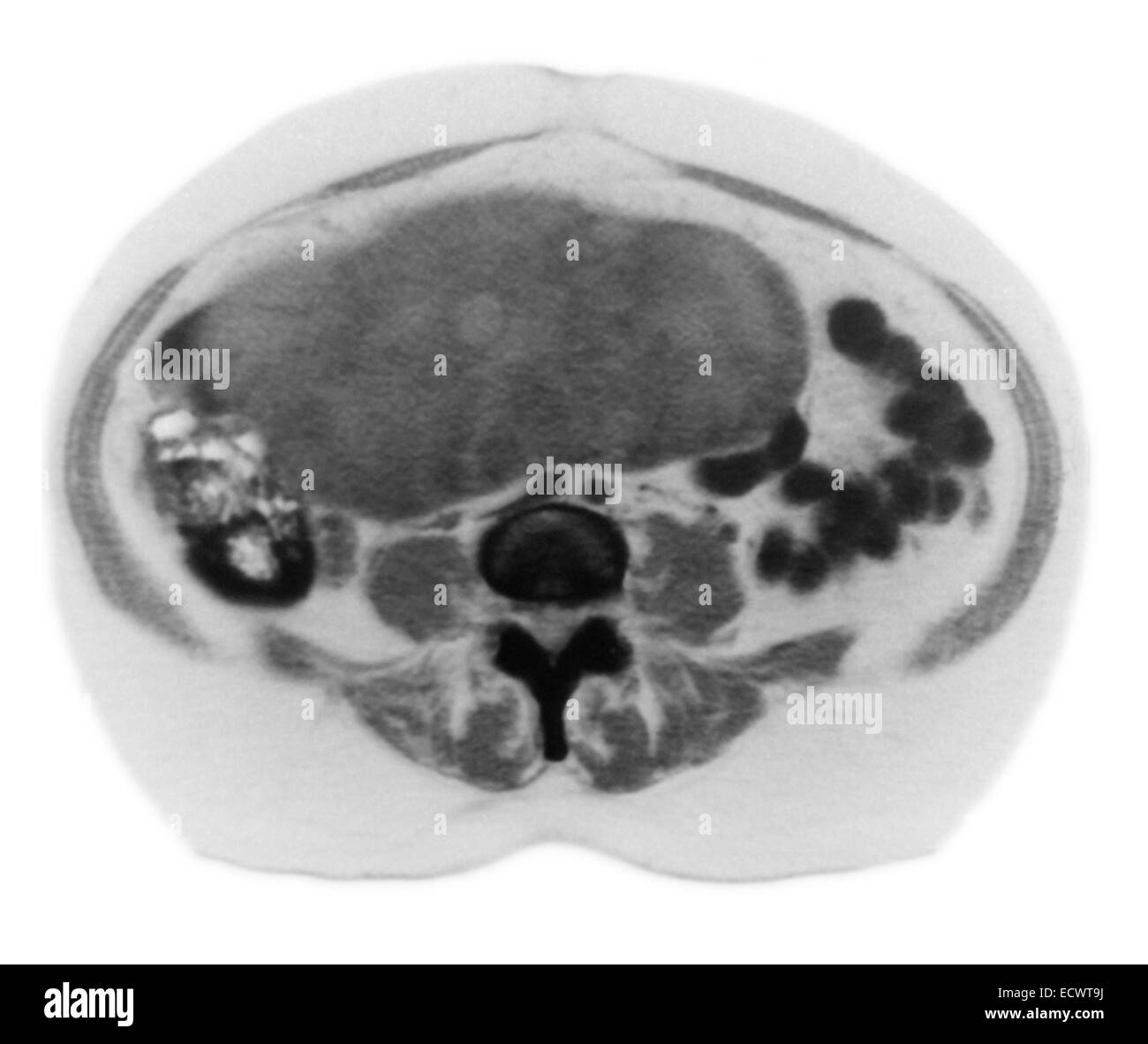 Eierstockkrebs auf CT-Scan. Stockfoto