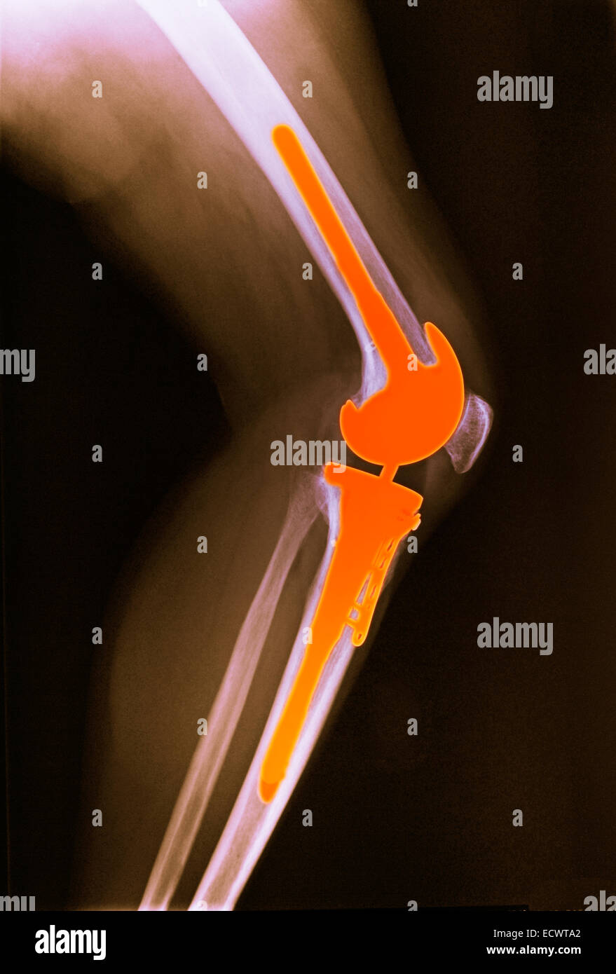 X-ray zeigt einer Knie-Totalprothese. Stockfoto