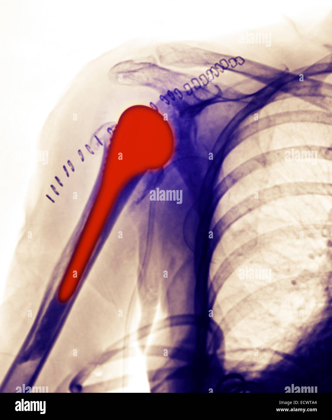 x-ray zeigt einen Schulter-Ersatz. Stockfoto