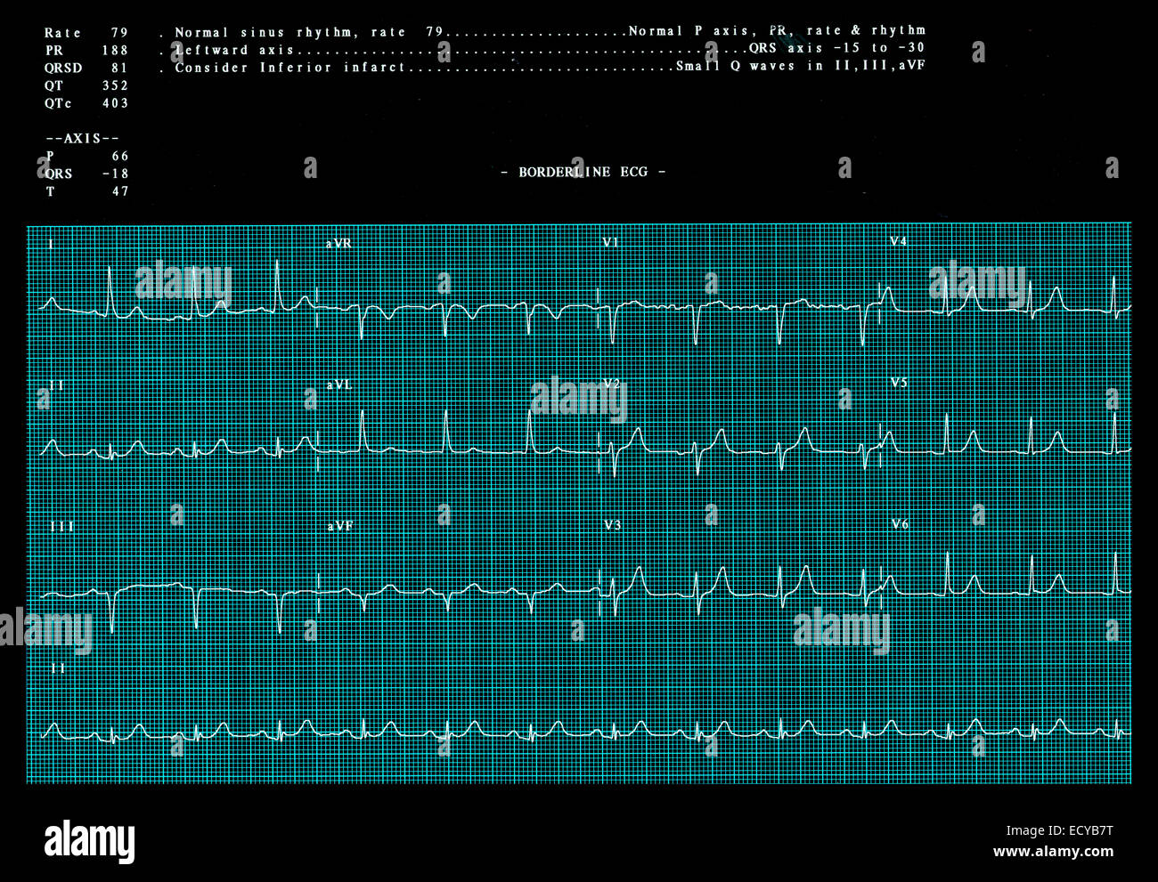 Normaler sinusrhythmus -Fotos und -Bildmaterial in hoher Auflösung – Alamy